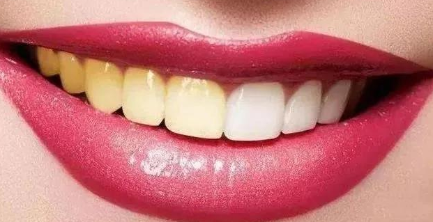 自然美白牙齒的方法有(yǒu)哪些？ 